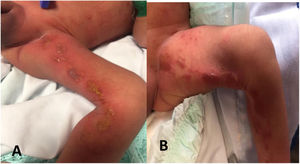 A, Vesiculobullous lesions with a diameter of 2 to 3mm on the inner aspect of the left leg along the lines of Blaschko. B, Verrucous, crusty lesions with hyperpigmentation.