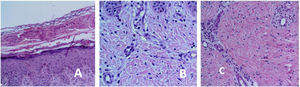 A, Epidermal acanthosis. Subcorneal vesicle with eosinophils. B, Epidermal acanthosis. Dermis with eosinophils. C, Perivascular dermal inflammatory infiltrate with eosinophils.