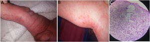 A and B, Verrucous (stage 2) lesions along the lines of Blaschko. C, Epidermis: spongiosis with intradermal spongiotic vesicles and exocytosis of numerous eosinophils. Dyskeratotic cells with hyaline cytoplasm. Dermis with edema and mononuclear superficial inflammatory infiltrate with eosinophils and melanophages.