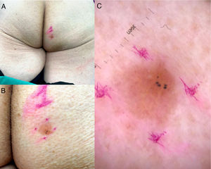 A and B, Slightly scaly erythematous yellowish plaque measuring 9mm×8mm in the right gluteal region. Note the well-defined borders and hyperpigmented area in the lower segment. C, Dermoscopy findings. Lesion with a pink background, some dotted and glomeruloid vessels, bright yellow anastomosing bundles, white and yellow dots, and blue-gray globules.