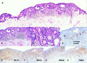 Reticulated acanthoma with sebaceous differentiation. A, Photomicrograph (hematoxylin–eosin [H–E], original magnification ×4). Neoplastic lesion with an adnexal epithelial appearance characterized by a proliferation of predominant eosinophilic keratinocytes. B, Photomicrograph (H–E, original magnification ×10). Small anastomosed foci with a more basaloid appearance. C, Photomicrograph (H–E, original magnification ×40). Clusters of sebocytes at the base of the anastomosing epithelial cords. D, Photomicrograph (original magnification ×10). Immunohistochemical staining for androgen receptors showing an evident sebaceous component. E, Photomicrograph (original magnification ×10). Immunohistochemical staining for MLH1 with an intact nuclear pattern. F, Photomicrograph (original magnification ×10). Immunohistochemical staining for MSH2 with an intact nuclear pattern. G, Photomicrograph (original magnification ×10). Immunohistochemical staining for MSH6 with an intact nuclear pattern. H, Photomicrograph (original magnification ×10). Immunohistochemical staining for PMS2 with an intact nuclear pattern.