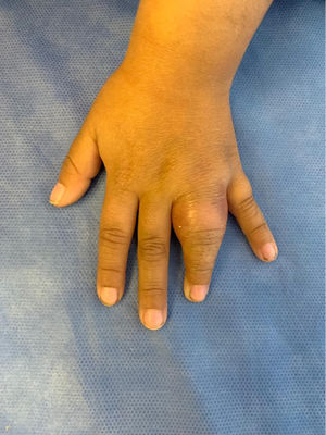 Photograph of the left hand showing swelling of the left finger with erythema and functional impairment.