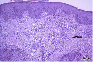 Histologic examination of skin biopsy specimen showing irregular acanthosis and orthokeratotic hyperkeratosis in the epidermis. Note the epithelioid granuloma in the superficial and mid dermis (arrow) (hematoxylin–eosin, original magnification ×100).