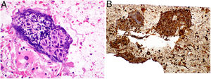 Cell block from a squamous cell carcinoma. (A) Hematoxylin and eosin stain, showing the pseudo architecture of a squamous cell carcinoma generated by the coagulation of an aspirate. (B) Immunohistochemistry staining positive for cytokeratin AE1/AE3.