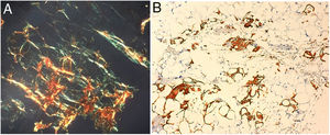 Cell block from an abdominal fat fine needle aspiration biopsy. (A) Congo Red stain. It is worth noting the green birefringence suggestive of amyloid deposits. (B) Immunohistochemistry staining positive for transthyretin.