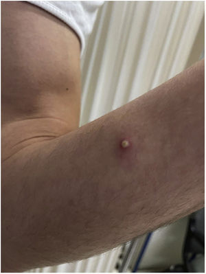 Lesión pustulosa umbilicada en antebrazo derecho.