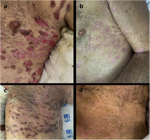 Clinical picture of patient 4 the day of the first infusion of rituximab 500mg (A) and the day of the second infusion after 2 weeks (B).