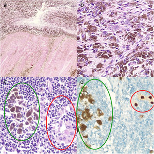 Cortes histológicos de ganglio linfático tras terapia diana con dabrafenib y trametinib. A. Múltiples melanófagos sobre un fondo de fibrosis en la parte superior y necrosis intensa en la parte inferior (hematoxilina y eosina, ×10). B. Melanófagos y CTV con mucha melanina intracitoplasmática, haciendo necesario el uso de técnicas adicionales como el marcador nuclear SOX10 para evaluar el porcentaje de CTV y, por tanto, el tipo de respuesta patológica (hematoxilina y eosina, ×20). C. Melanófagos a la izquierda con melanina intracitoplasmática (marcados con verde), y a la derecha CTV aisladas (marcadas con rojo) (hematoxilina y eosina ×100). D. Captación nuclear para las CTV (marcadas con rojo) y captación citoplasmática de los melanófagos sin tinción nuclear (marcados con verde) (inmunohistoquímica para SOX10, ×100).
