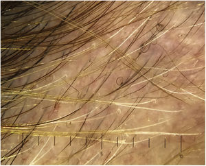 Pelos en cola de cerdo (pigtail hairs or circle hairs).