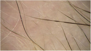 Constricciones de Pohl-Pinkus.