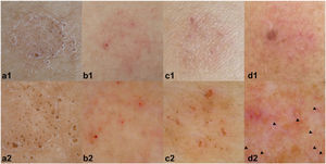 Irritant reactions. Upper row (1), clinical images; lower row (2), dermoscopic reactions. (a2) Pore pattern, (b2) perifollicular erythema, (c2) pore pattern and perifollicular erythema, and (d2) mainly perifollicular erythema and linear vessels (black arrowheads).
