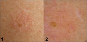 Doubtful reaction. (1) Clinical image, (2) Dermoscopic image, areas of erythema not limited to perifollicular areas in <50% of the chamber.