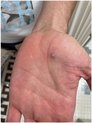 Umbilicated pustular lesion on the left hand.