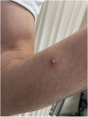 Umbilicated pustular lesion on the right forearm.