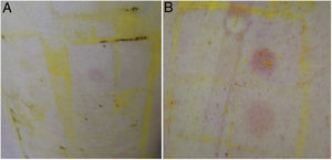 (A) Example of a weak positive reaction (+) to shellac. (B) Example of a positive reaction (++) to shellac. This is the positive reaction seen in the upper quadrant; the lower quadrant corresponds to a reaction (+) to gallate mix.