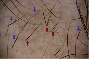 Blue arrows, exclamation mark hairs; red arrows, broken hairs.