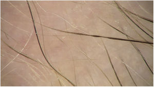 Pohl-Pinkus constrictions.