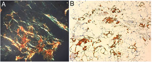 Bloque celular procedente de biopsia por aspiración con aguja fina abdominal. A)Tinción rojo Congo: cabe resaltar la birrefringencia verde sugestiva de depósitos de amiloides. B)Tinción de inmunohistoquímica positiva para transtiretina.