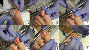 Bloqueo locorregional del dedo mediante infiltración de anestésico local, mepivacaína al 2% a dosis de 0,5 mL/kg (A); con una pinza hemostática tipo mosquito recta se empuja proximalmente debajo de la lámina ungueal hasta el eponiquio, y 1/4 del borde lateral de la lámina ungueal se separa del lecho ungueal (B); corte de la placa ungueal lateral con tijera, llegando a la base de la uña, completando la onicectomía parcial (C); aspecto final del lecho ungueal tras onicectomía parcial (D); cauterización de la matriz con nitrato de plata aplicado en barra de 50 mg (Argenpal®) en el lecho ungueal durante 5-10 seg (E); aspecto final después del procedimiento quirúrgico (F).