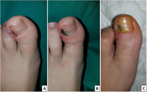 Uña encarnada antes del procedimiento quirúrgico (A), características clínicas inmediatamente después de la intervención (B) y siete días después del procedimiento (C).