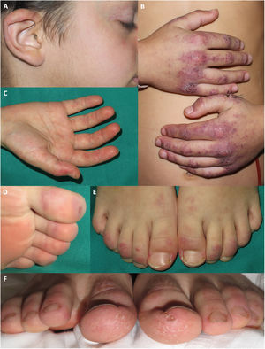 Manifestaciones acrales en pacientes diagnosticados de dermatomiositis juvenil en nuestro hospital durante la pandemia de COVID. Placas eritemato purpúricas en la oreja de un paciente que además presenta telangiectasias en los párpados y queilitis. B) Placas eritemato purpúricas con descamación en el dorso de las manos, con afectación más extensa que la observada en las típicas pápulas de Gottron. C) Eritema palmar. D) Máculas purpúricas los dedos de los pies. E) Placas eritemato descamativas en el dorso de los dedos de los pies. F) Placas eritemato descamativas en los dedos de los pies, asociada a descamación, fisuración y una úlcera en la región plantar de los dedos.