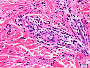 Imagen histológica a mayor aumento, que muestra la lesión centrada en la dermis con un infiltrado de predominio linfocitario y leucocitoclasia abundante y extravasación hemática (tinción de hematoxilina-eosina, magnificación ×20).