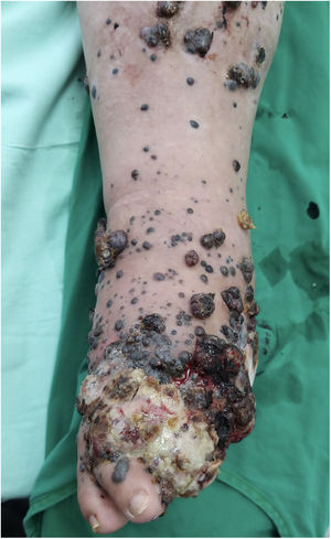 Progresión tumoral acelerada de recaída locorregional de melanoma lentiginoso acral.