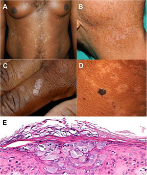 Epidermodisplasia verruciforme. A y B. Máculas hipopigmentadas tipo pitiriasis versicolor en paciente con fototipo alto y fototipo bajo, respectivamente. C. Lesiones tipo verruga plana en el dorso de la mano. D. Lesiones tipo queratosis seborreica y máculas hipopigmentadas tipo pitiriasis versicolor en paciente con fototipo alto. E. Histología característica de epidermodisplasia verruciforme; queratinocitos engrosados con citoplasma azul-grisáceo en el estrato espinoso con gránulos queratohialinos en su interior (hematoxilina-eosina, ×20).