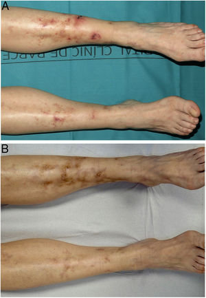 Vasculopatía livedoide (paciente 3). A. Úlceras, eritema y cicatrices atróficas en las piernas y tobillos. B. Respuesta completa tras 3 meses de tratamiento con rivaroxabán.