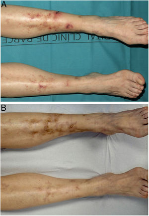 Vasculopatía livedoide (paciente 3). A. Úlceras, eritema y cicatrices atróficas en las piernas y tobillos. B. Respuesta completa tras 3 meses de tratamiento con rivaroxabán.