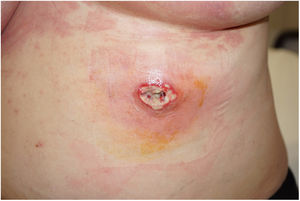 Pioderma gangrenoso en el tronco.