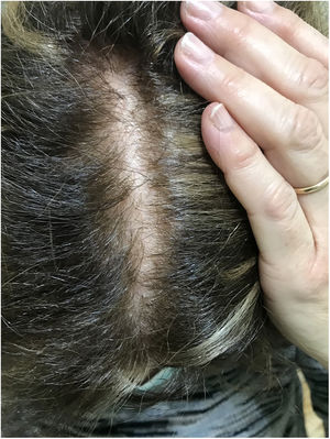 Cuero cabelludo sensible primario: piel normal coincidente con alopecia androgénica.
