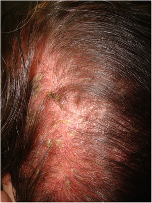 Cuero cabelludo sensible primario: piel eritematosa coincidente con efluvio telógeno.