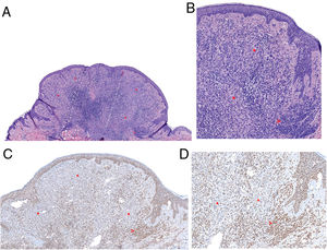 Imágenes histológicas. A) Proliferación melanocítica intradérmica polipoide combinada, con presencia de una población melanocítica en periferia compatible con un nevus ordinario (flecha) y una segunda población central spitzoide (asteriscos). Adicionalmente se observa un moderado infiltrado inflamatorio linfocitario (H&E, x40). B) Nevus ordinario en periferia constituido por nidos de melanocitos pequeños clonales (flecha). Población central spitzoide, con un citoplasma amplio eosinófilo y con discreto pleomorfismo nuclear, sin evidencia de mitosis (H&E, x100). C) y D) El estudio inmunohistoquímico demostró pérdida de la expresión de BAP1 en el componente spitzoide de la lesión (asteriscos), y no en el componente de nevus ordinario (flecha) (BAP1, x100 y x200).