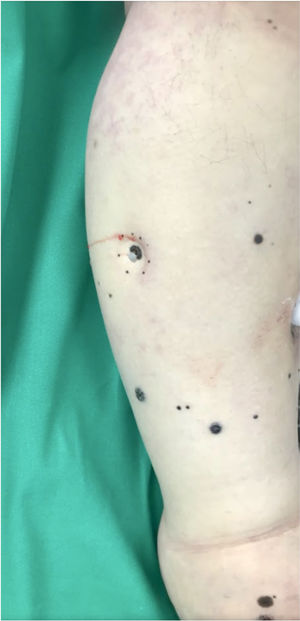 Locoregional recurrence of acral lentiginous melanoma.