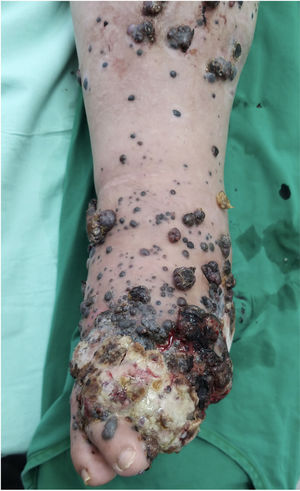 Rapid progression following locoregional recurrence of acral lentiginous melanoma.