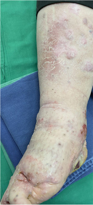 Clinical outcome after nivolumab and cryosurgery.