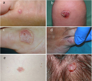 Clinical appearance of the poromas. A–C, Acral lesions with erythematous coloration. D, Nonspecific exophytic lesion on the dorsum of the toe. E, Brownish plaque on the trunk. F, Exophytic lesion on the scalp.
