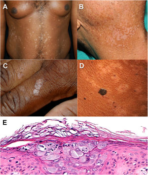 Epidermodysplasia verruciformis. A and B, Pityriasis versicolor-like hypopigmented macules in 2 patients with a low and high Fitzpatrick skin type. C, Verruca plana-like lesions on the dorsum of the hand. D, Seborrheic keratosis-like lesions and hypopigmented pityriasis versicolor-like macules in a patient with a high Fitzpatrick skin type. E, Characteristic histology findings in epidermodysplasia verruciformis. Note the thickened keratinocytes with grayish-blue cytoplasm in the stratum spinosum and keratohyaline granules in the interior (hematoxylin–eosin, original magnification ×20).