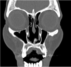 Computed tomography scan of the patient in Fig. 2. Note the perforation of the nasal septum.