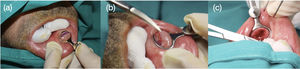 (A) Chalazion forceps placed on the lower lip. (B) Surface dissection. (C) Suture before withdrawal of the chalazion forceps.