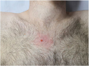 Orange papule with a diameter of 5mm and perilesional erythema in the right pectoral area.