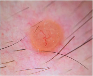 Dermoscopic image showing a structureless, homogeneous orange pattern with multiple serpentine vessels distributed throughout the lesion and a branched, larger-caliber telangiectatic vessel crossing the lesion eccentrically.