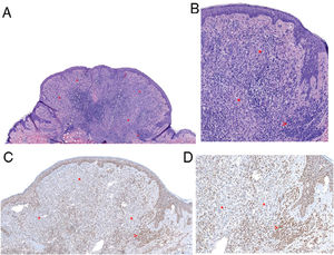 Histologic images. A, Combined polypoid intradermal melanocytic proliferation with a peripheral melanocytic population consistent with a common nevus (arrow) and a second central spitzoid population (asterisks). Note the moderate lymphocytic inflammatory infiltrate (hematoxylin–eosin, original magnification 40). B, Common nevus at the periphery comprising nests of small clonal melanocytes (arrow). Central spitzoid population, with an abundant eosinophilic cytoplasm and discrete nuclear pleomorphism and no evidence of mitosis (hematoxylin–eosin, original magnification 100). C and D, Immunohistochemistry showing loss of BAP1 expression in the spitzoid (asterisks) but not common nevus component (arrow) of the lesion (BAP1, original magnification 100 and 200, respectively).