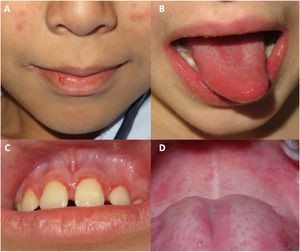 Lesions on the oral mucosa in patients diagnosed with juvenile dermatomyositis in our hospital during the COVID pandemic. A, Cheilitis; B, cheilitis-associated depapillation of the tongue; C, erythema and edema of the lips; D, erythematous macules and telangiectasias on the palate.
