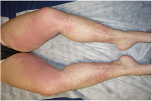 Nonpalpable purpuric spots on both lower limbs, with scattered petechial lesions on the legs and the dorsal aspect of the feet, and Rumpel-Leede phenomenon on the inner aspect of both legs, coinciding with the seam of the pants.