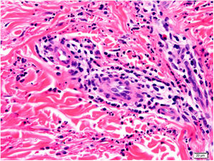 Higher magnification histological image, showing the lesion centered on the dermis with a predominantly lymphocytic infiltrate and abundant leukocytoclasia and hematic extravasation (hematoxylin–eosin staining, original magnification ×20).