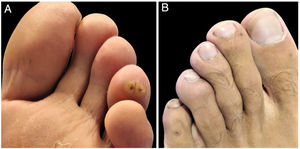 Pápulas hiperqueratósicas de color amarillo amarronado (A) y pápulas pequeñas rojas (B) con puntos centrales oscuros.