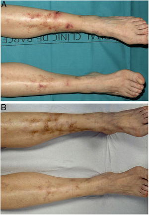Livedoid vasculopathy (patient #3). A, Ulcers and erosions, erythema, and atrophic scars on the ankles and feet. B, Complete response after 3 months of treatment with rivaroxaban.