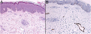 Tinción con hematoxilina-eosina (HE). Se observa también edema en la dermis, intercalado con fibrosis y con escaso infiltrado linfoide perivascular superficial (A). Tinción para podoplanina (D2-40) en la que destacan algunos vasos linfáticos ectásicos dérmicos (B).
